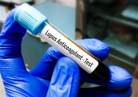 Anticoagulant lupique : Test, Syndrome, Positif, Grossesse, et。